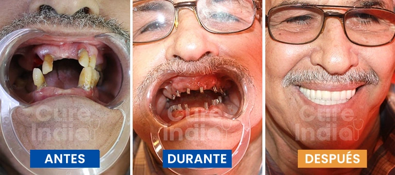 precio implantes dentales para toda boca